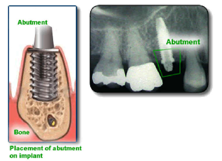 Dr. Hogan, Dental Implants, Columbia Periodontist, South Carolina, SC